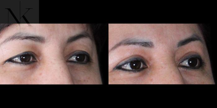 Before & After Upper Blepharoplasty Case 182 Right Oblique View in Wethersfield, Hartford, Nebraska