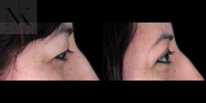 Before & After Upper Blepharoplasty Case 182 Right Side View in Wethersfield, Hartford, Nebraska