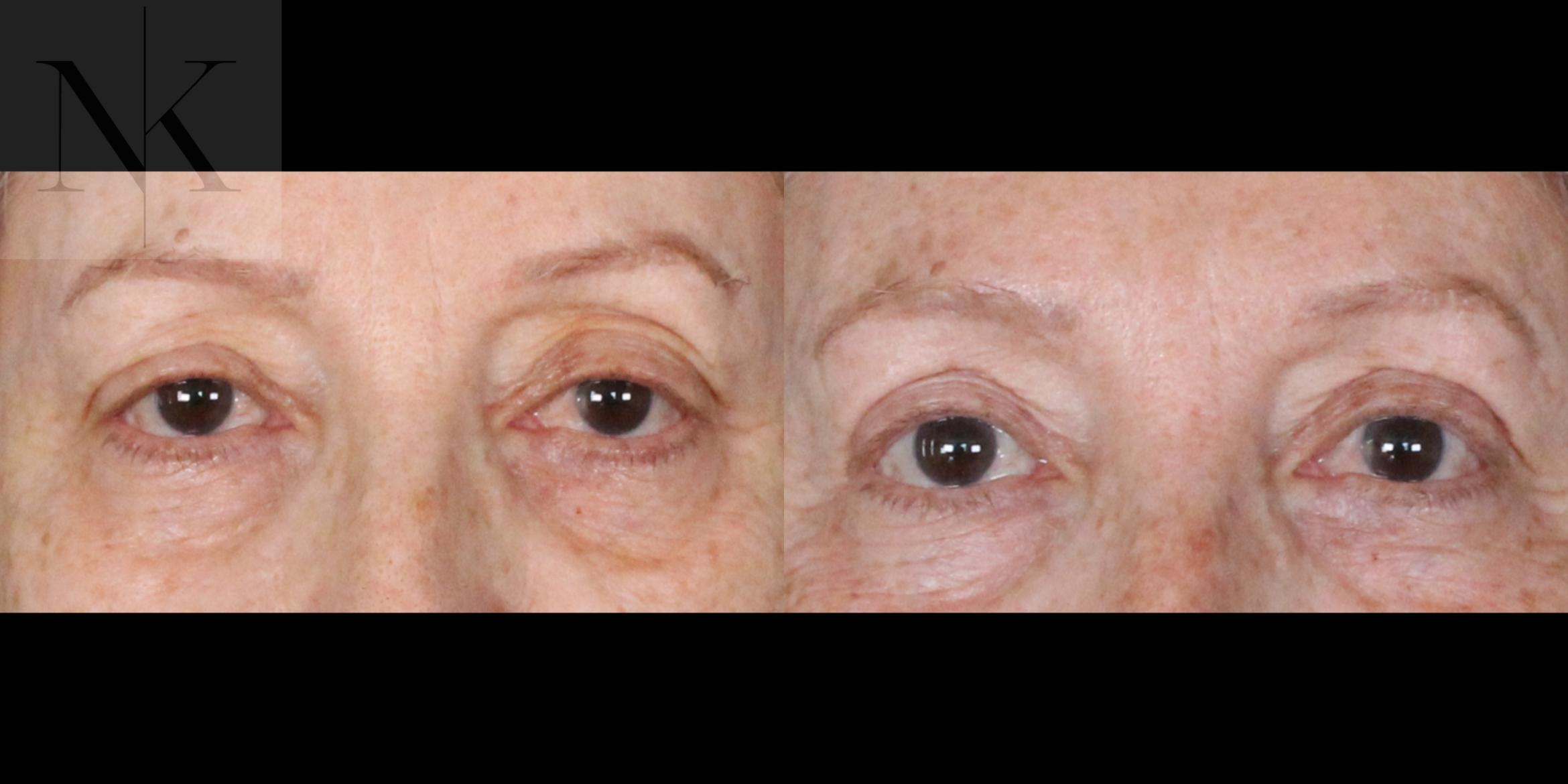 Before & After Upper Blepharoplasty Case 183 Front View in Wethersfield, Hartford, Nebraska