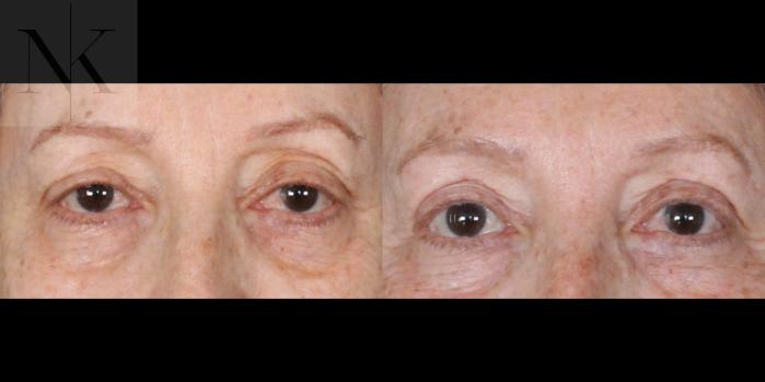 Before & After Upper Blepharoplasty Case 183 Front View in Wethersfield, Hartford, Nebraska