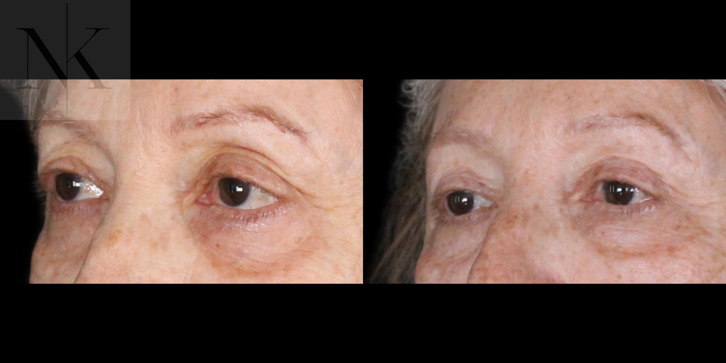Before & After Upper Blepharoplasty Case 183 Left Oblique View in Wethersfield, Hartford, Nebraska