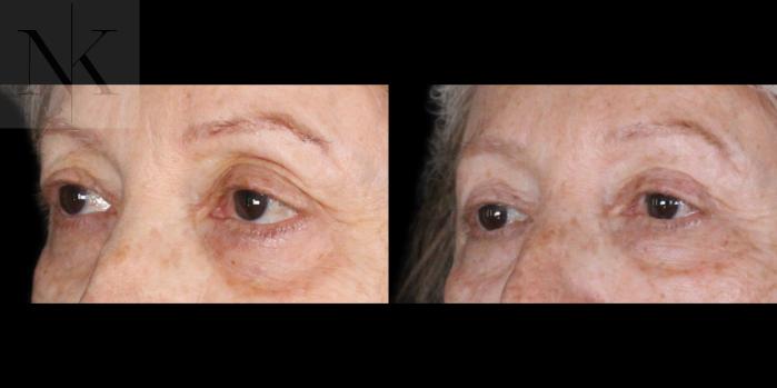 Before & After Upper Blepharoplasty Case 183 Left Oblique View in Wethersfield, Hartford, Nebraska