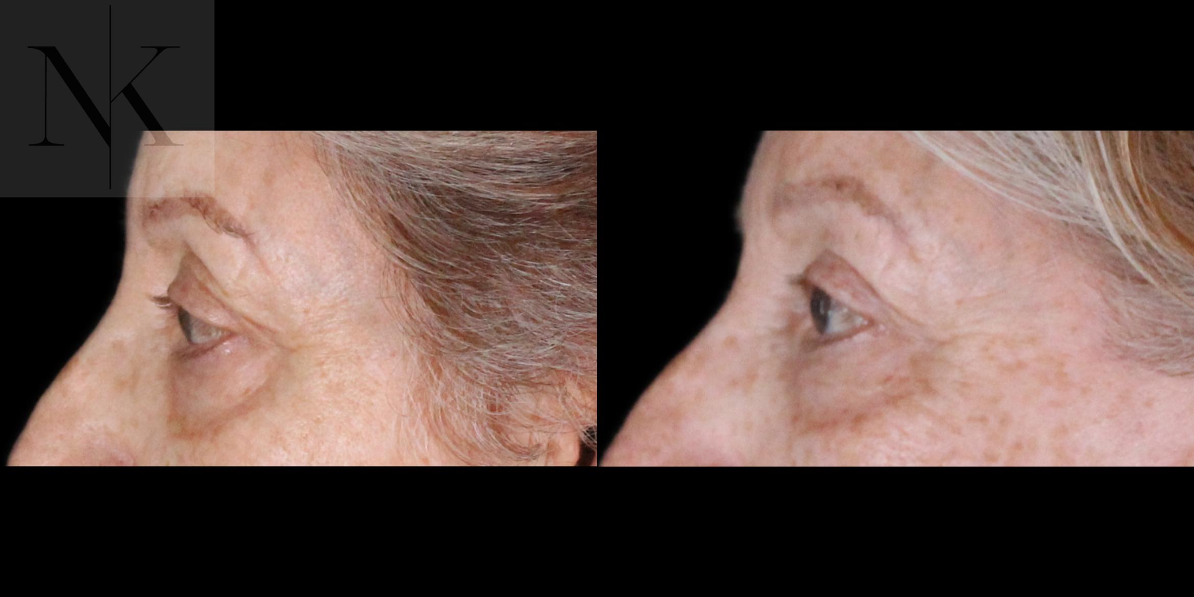 Before & After Upper Blepharoplasty Case 183 Left Side View in Wethersfield, Hartford, Nebraska