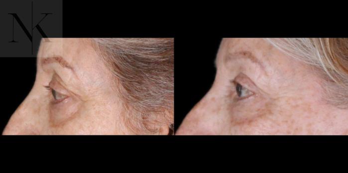 Before & After Upper Blepharoplasty Case 183 Left Side View in Wethersfield, Hartford, Nebraska