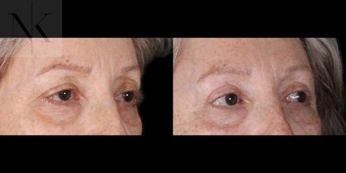 Before & After Upper Blepharoplasty Case 183 Right Oblique View in Wethersfield, Hartford, Nebraska
