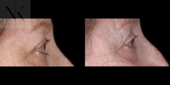Before & After Upper Blepharoplasty Case 183 Right Side View in Wethersfield, Hartford, Nebraska