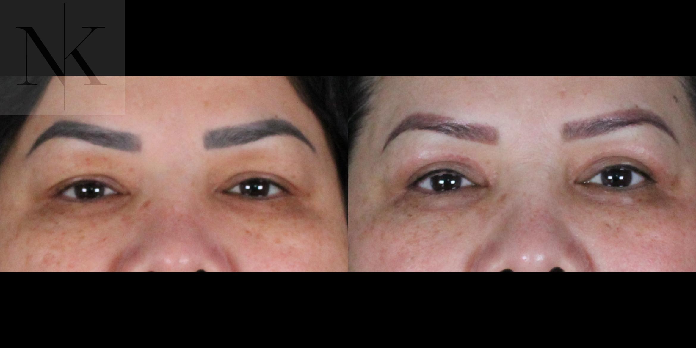 Before & After Upper Blepharoplasty Case 184 Front View in Wethersfield, Hartford, Nebraska