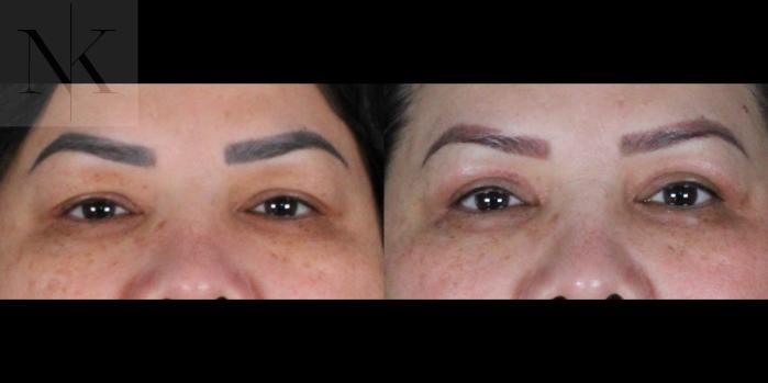 Before & After Upper Blepharoplasty Case 184 Front View in Wethersfield, Hartford, Nebraska