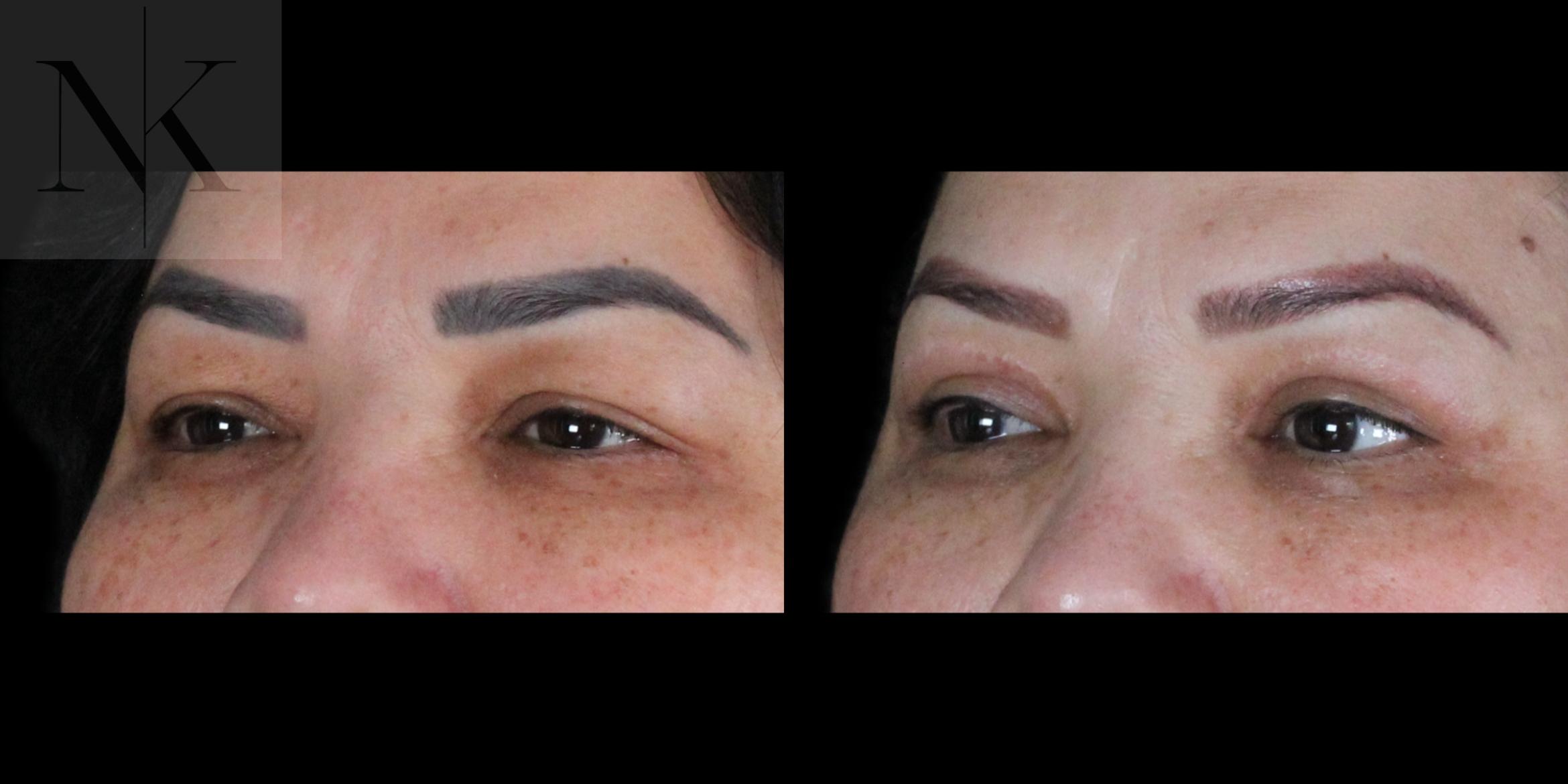 Before & After Upper Blepharoplasty Case 184 Left Oblique View in Wethersfield, Hartford, Nebraska
