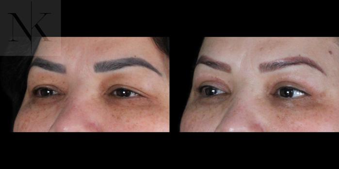 Before & After Upper Blepharoplasty Case 184 Left Oblique View in Wethersfield, Hartford, Nebraska