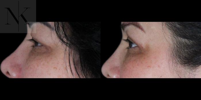 Before & After Upper Blepharoplasty Case 184 Left Side View in Wethersfield, Hartford, Nebraska
