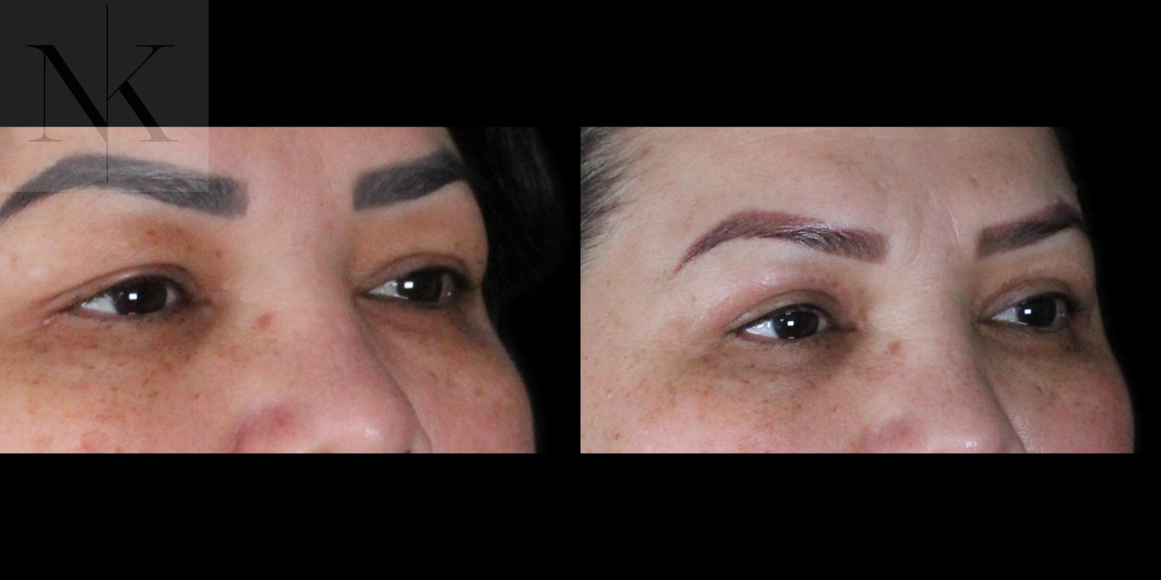 Before & After Upper Blepharoplasty Case 184 Right Oblique View in Wethersfield, Hartford, Nebraska