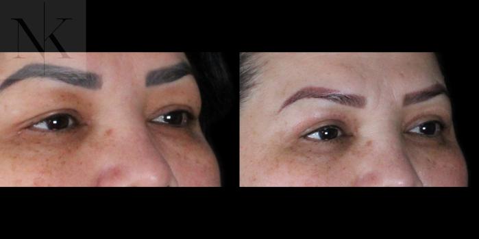 Before & After Upper Blepharoplasty Case 184 Right Oblique View in Wethersfield, Hartford, Nebraska