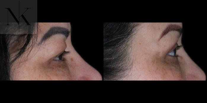 Before & After Upper Blepharoplasty Case 184 Right Side View in Wethersfield, Hartford, Nebraska