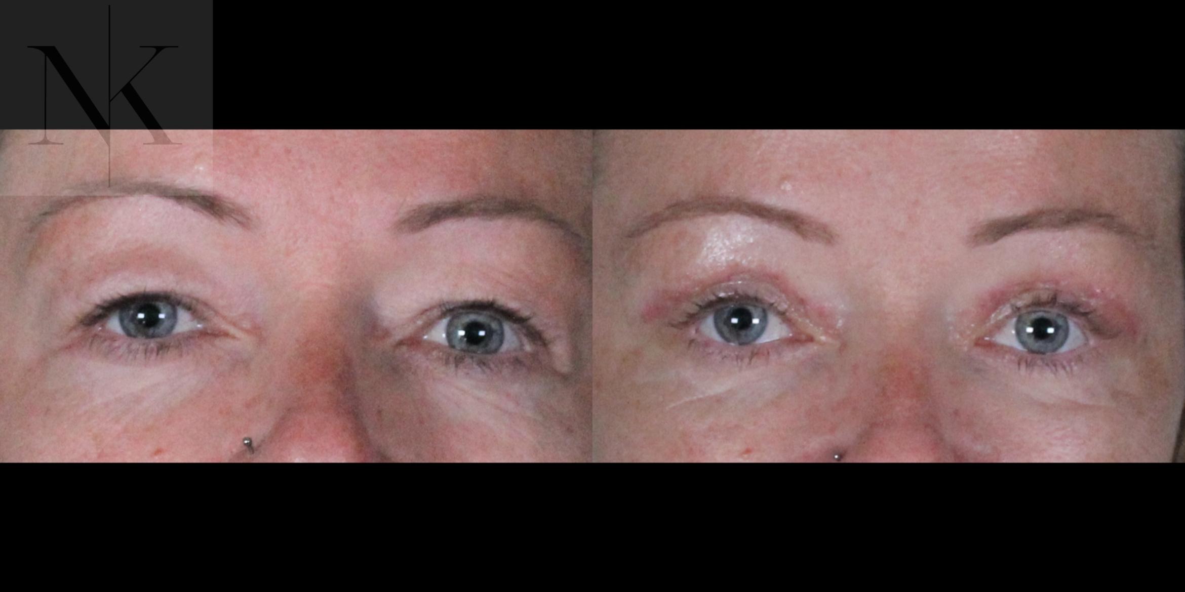 Before & After Upper Blepharoplasty Case 185 Front View in Wethersfield, Hartford, Nebraska