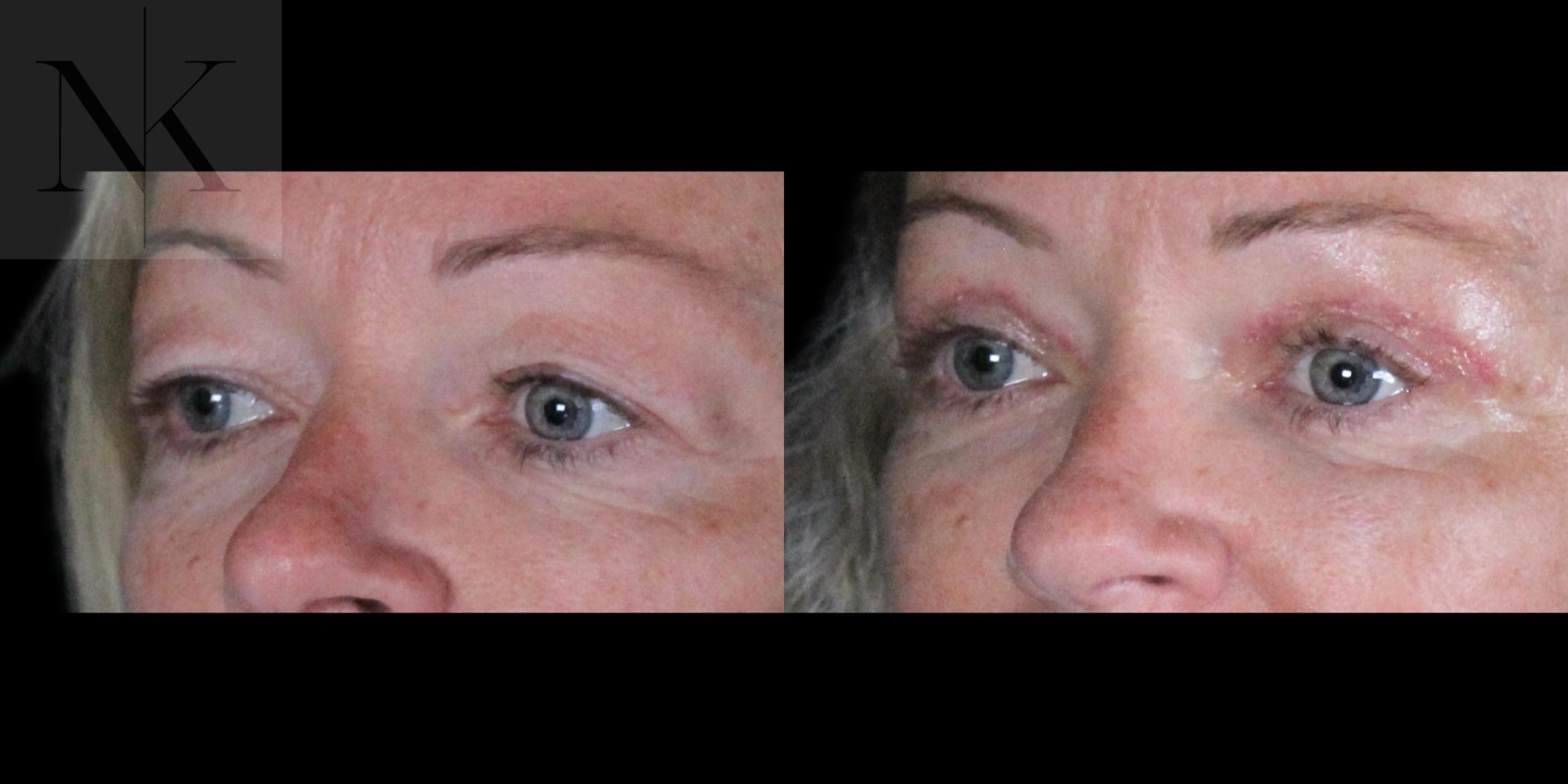 Before & After Upper Blepharoplasty Case 185 Left Oblique View in Wethersfield, Hartford, Nebraska