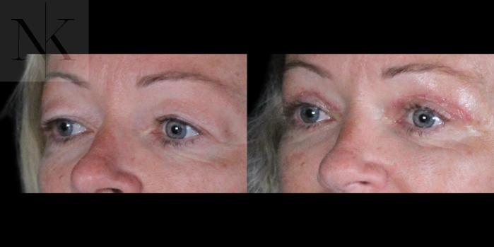 Before & After Upper Blepharoplasty Case 185 Left Oblique View in Wethersfield, Hartford, Nebraska