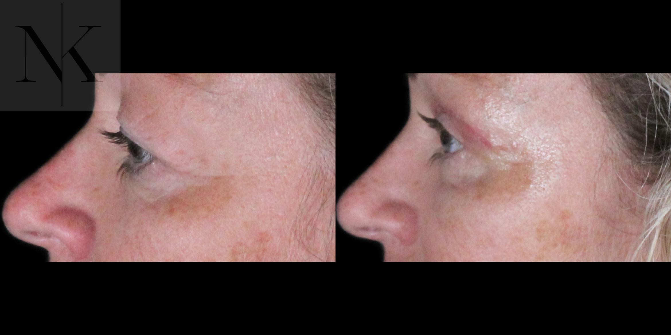Before & After Upper Blepharoplasty Case 185 Left Side View in Wethersfield, Hartford, Nebraska