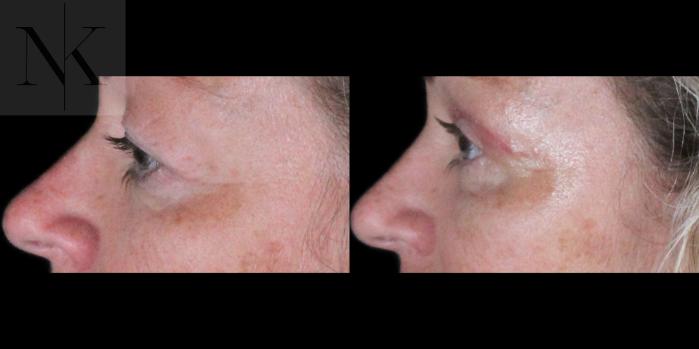 Before & After Upper Blepharoplasty Case 185 Left Side View in Wethersfield, Hartford, Nebraska
