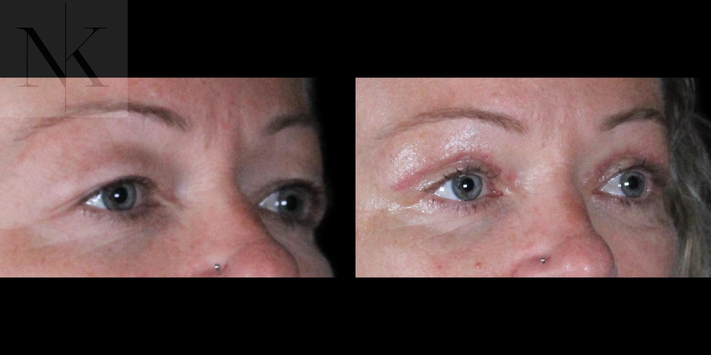 Before & After Upper Blepharoplasty Case 185 Right Oblique View in Wethersfield, Hartford, Nebraska