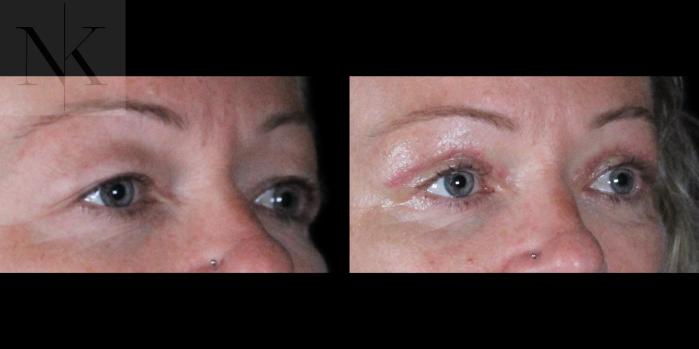 Before & After Upper Blepharoplasty Case 185 Right Oblique View in Wethersfield, Hartford, Nebraska