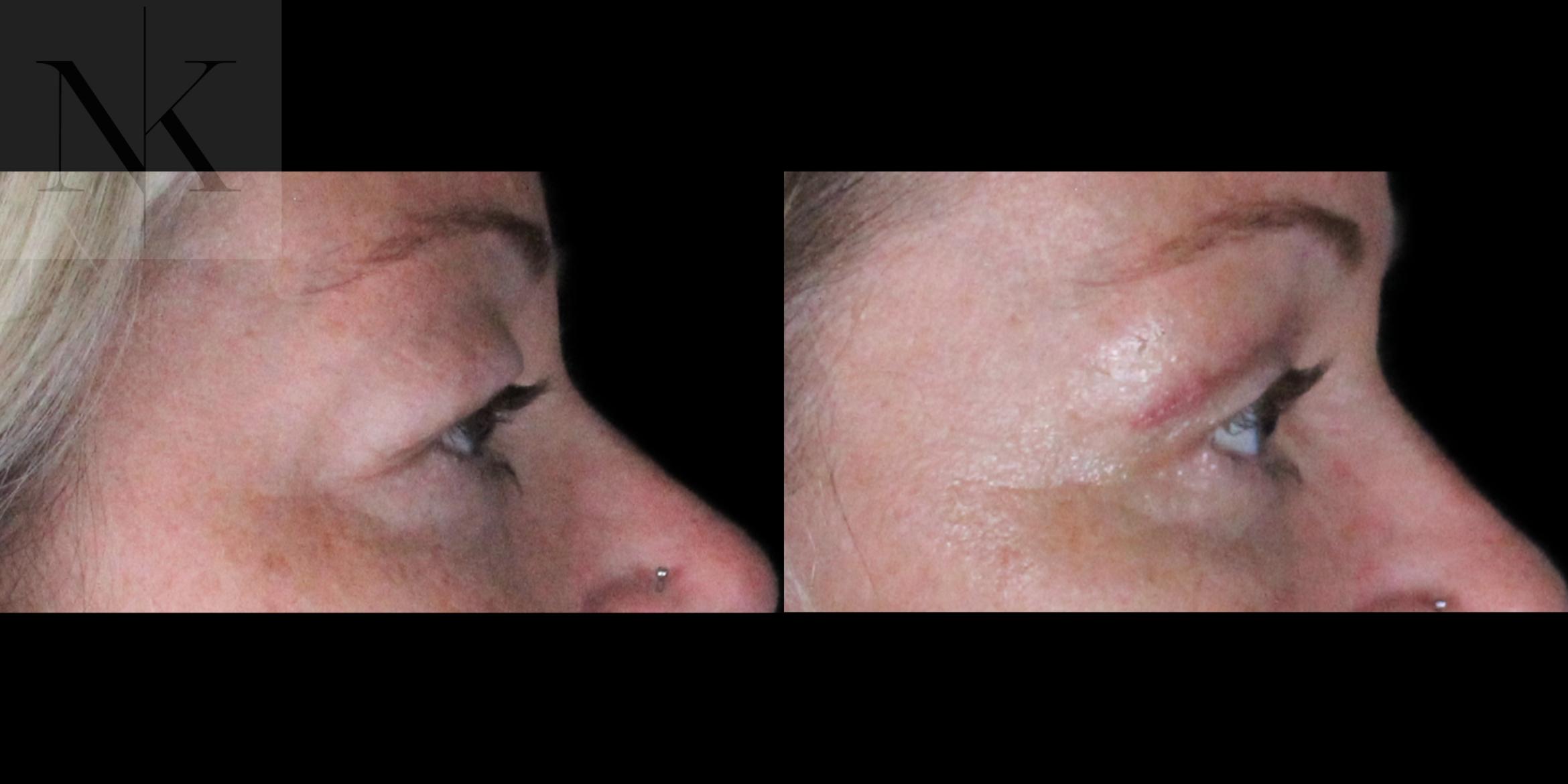 Before & After Upper Blepharoplasty Case 185 Right Side View in Wethersfield, Hartford, Nebraska