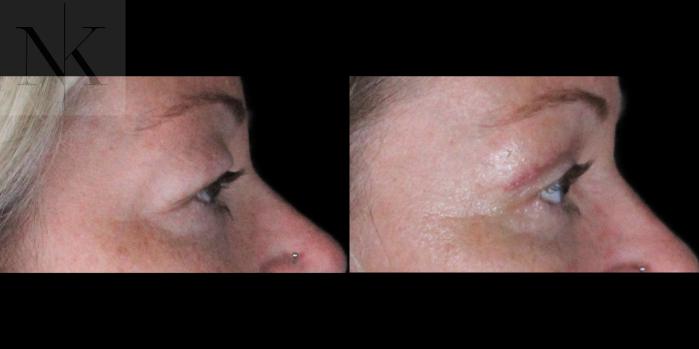 Before & After Upper Blepharoplasty Case 185 Right Side View in Wethersfield, Hartford, Nebraska