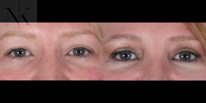 Before & After Upper Blepharoplasty Case 186 Front View in Wethersfield, Hartford, Nebraska