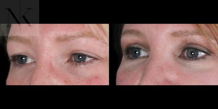 Before & After Upper Blepharoplasty Case 186 Left Oblique View in Wethersfield, Hartford, Nebraska
