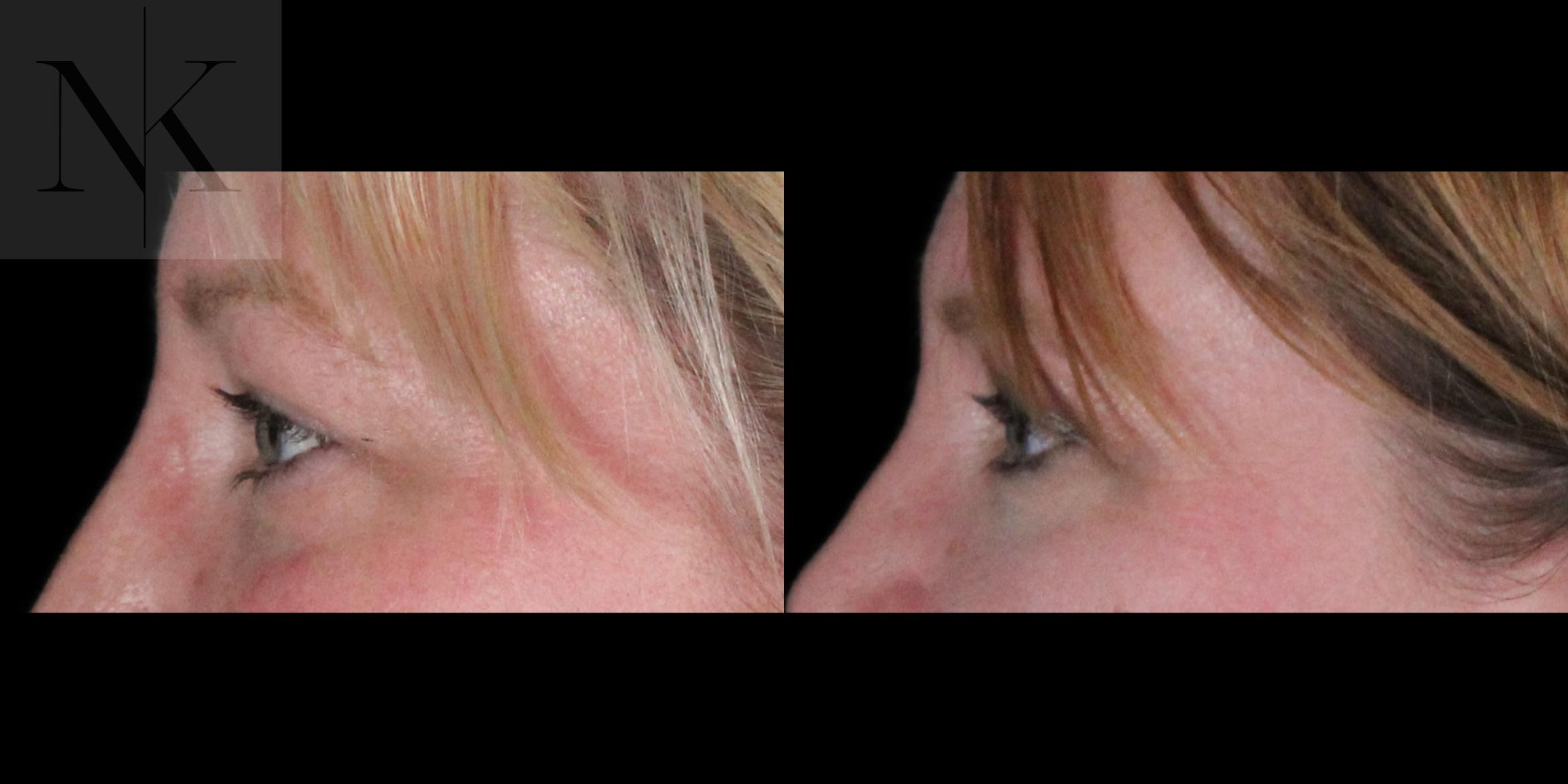 Before & After Upper Blepharoplasty Case 186 Left Side View in Wethersfield, Hartford, Nebraska