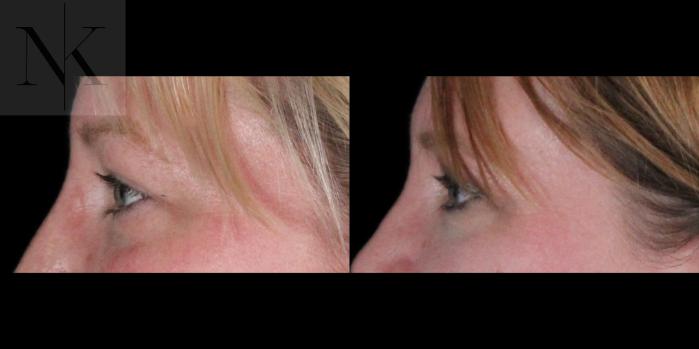Before & After Upper Blepharoplasty Case 186 Left Side View in Wethersfield, Hartford, Nebraska