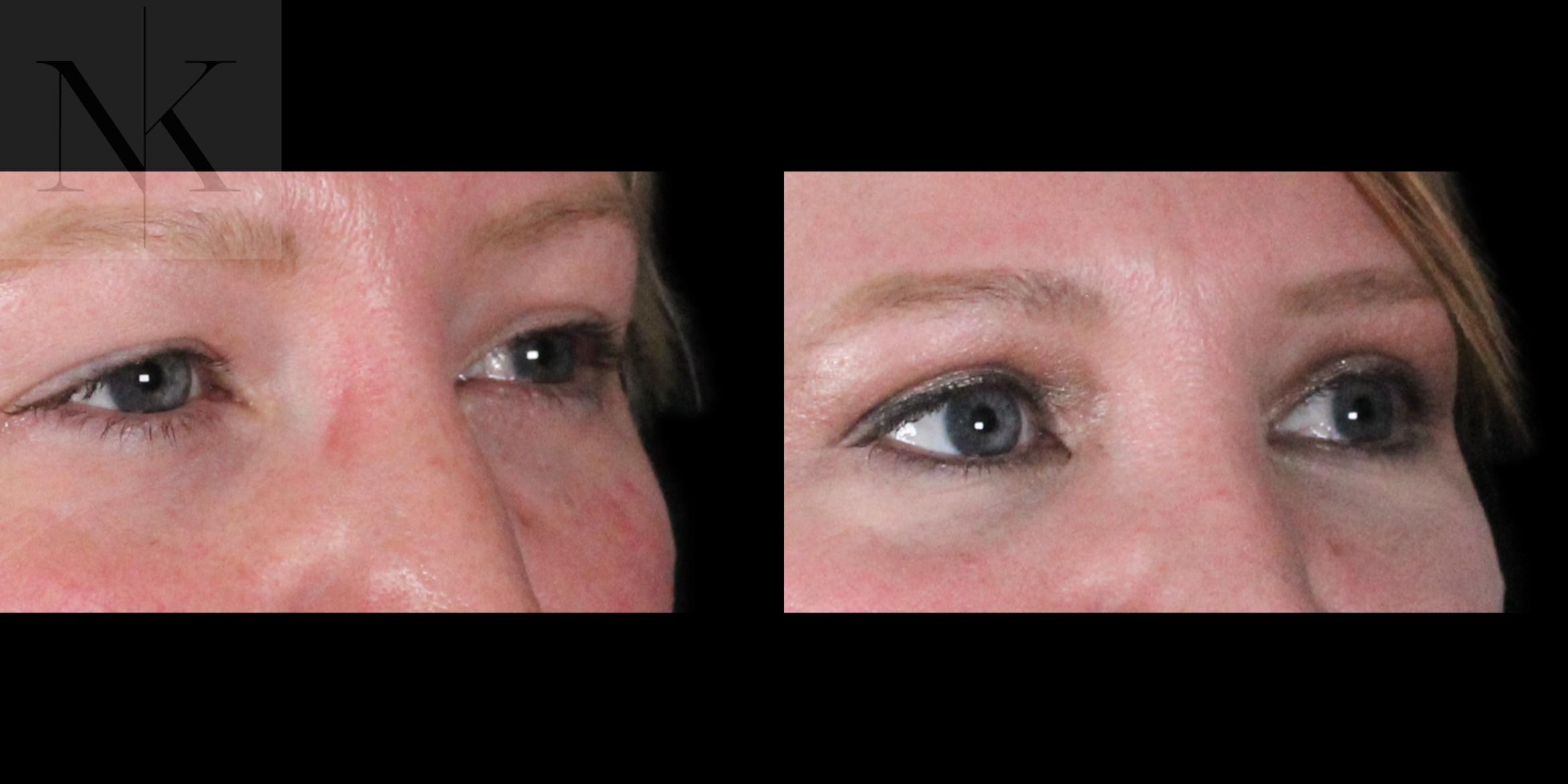 Before & After Upper Blepharoplasty Case 186 Right Oblique View in Wethersfield, Hartford, Nebraska