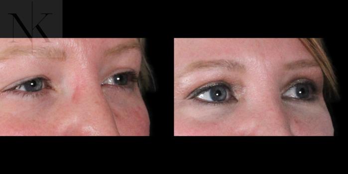 Before & After Upper Blepharoplasty Case 186 Right Oblique View in Wethersfield, Hartford, Nebraska