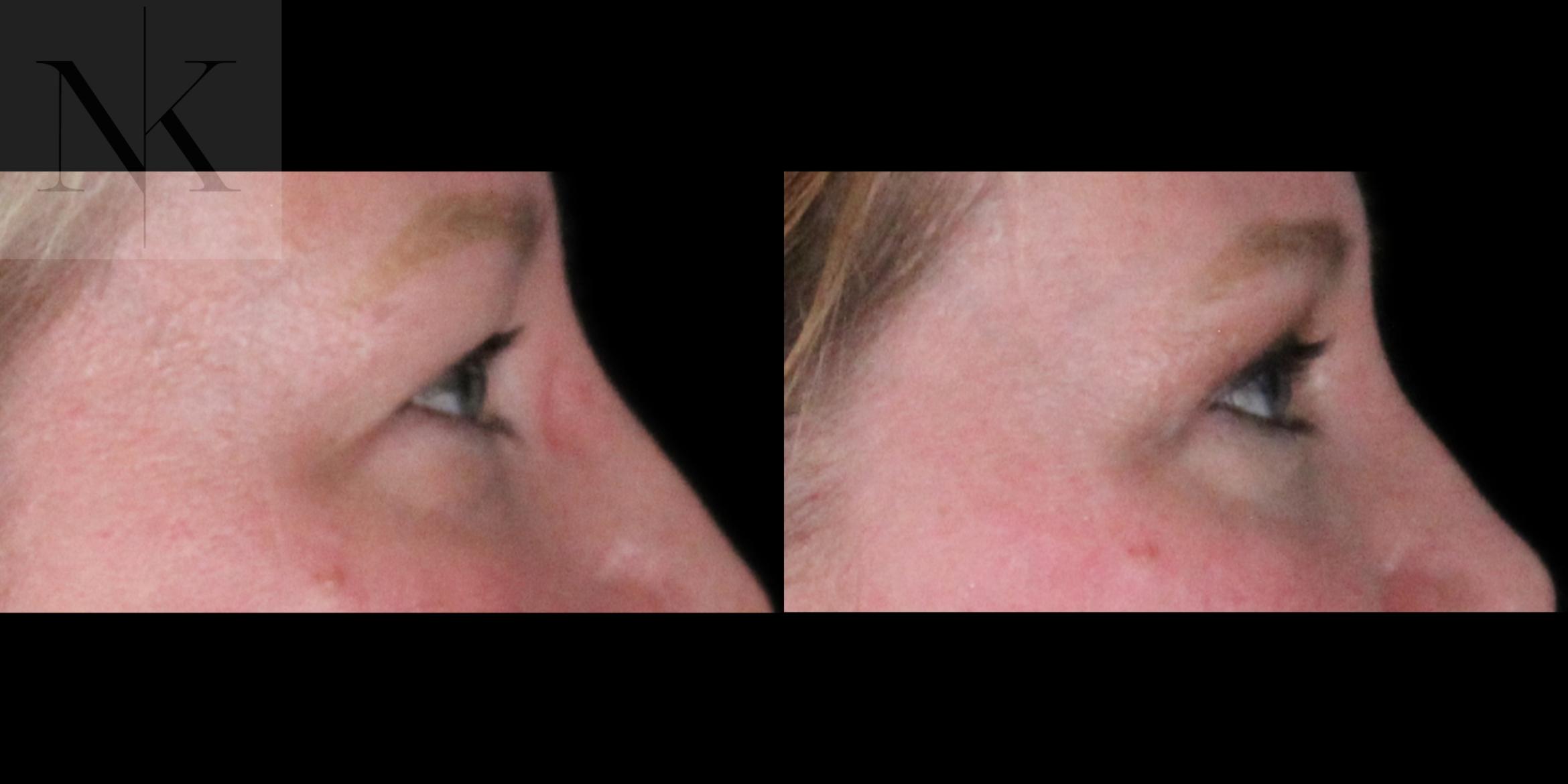 Before & After Upper Blepharoplasty Case 186 Right Side View in Wethersfield, Hartford, Nebraska
