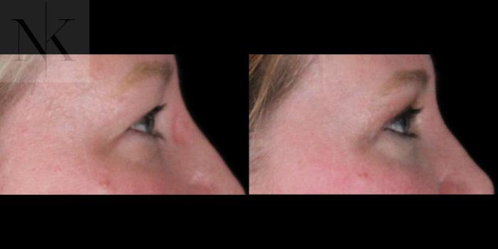 Before & After Upper Blepharoplasty Case 186 Right Side View in Wethersfield, Hartford, Nebraska