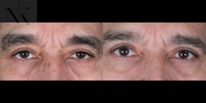 Before & After Upper Blepharoplasty Case 195 Front View in Wethersfield, Hartford, Nebraska