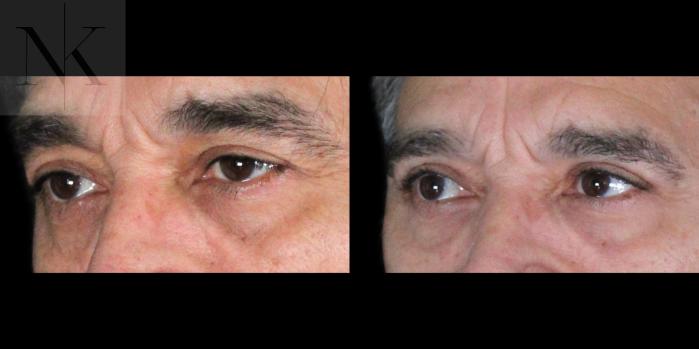 Before & After Upper Blepharoplasty Case 195 Left Oblique View in Wethersfield, Hartford, Nebraska
