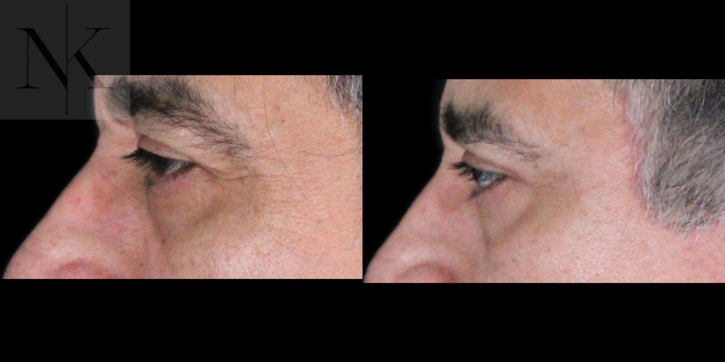 Before & After Upper Blepharoplasty Case 195 Left Side View in Wethersfield, Hartford, Nebraska