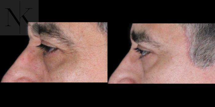 Before & After Upper Blepharoplasty Case 195 Left Side View in Wethersfield, Hartford, Nebraska