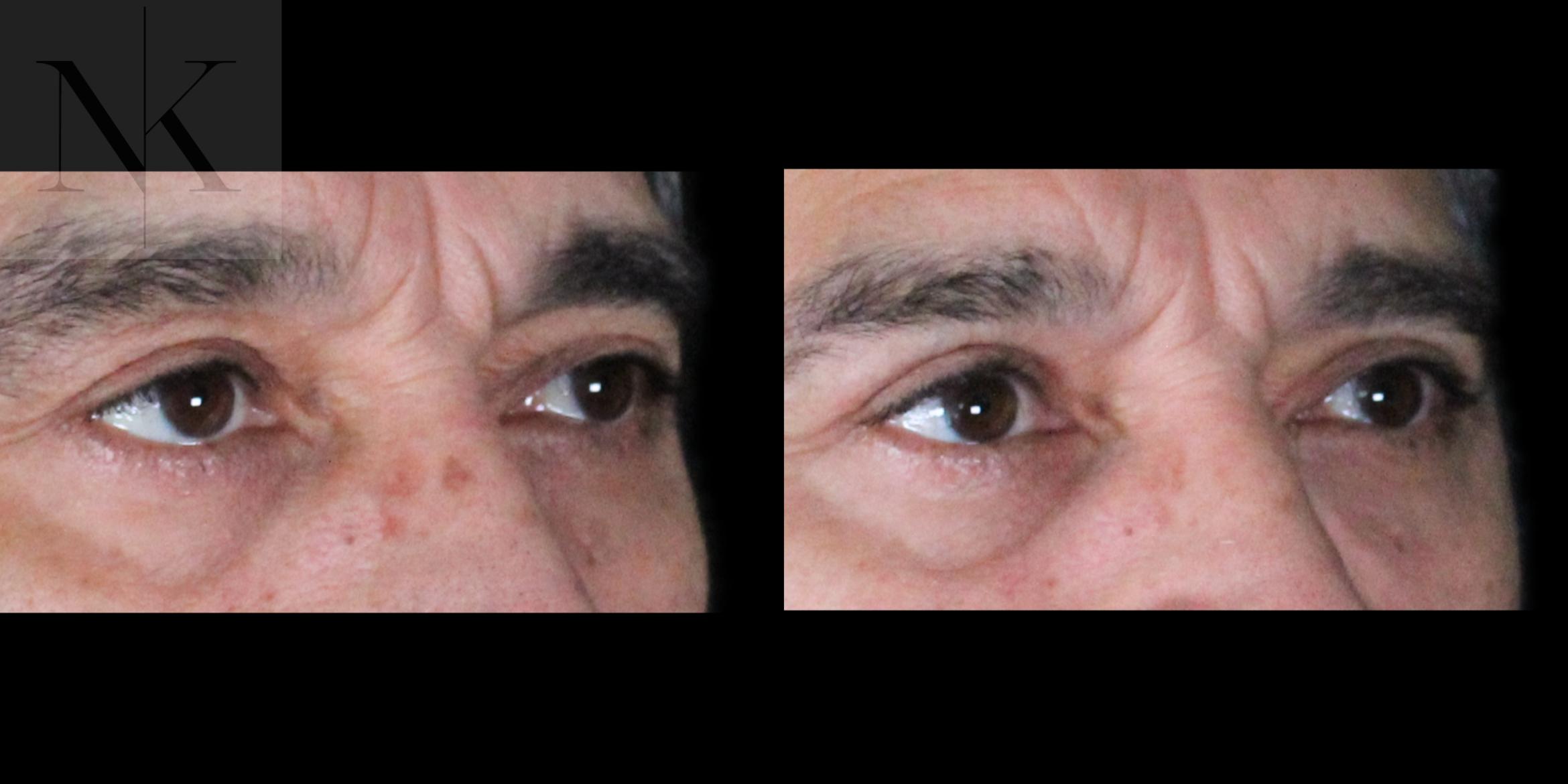 Before & After Upper Blepharoplasty Case 195 Right Oblique View in Wethersfield, Hartford, Nebraska