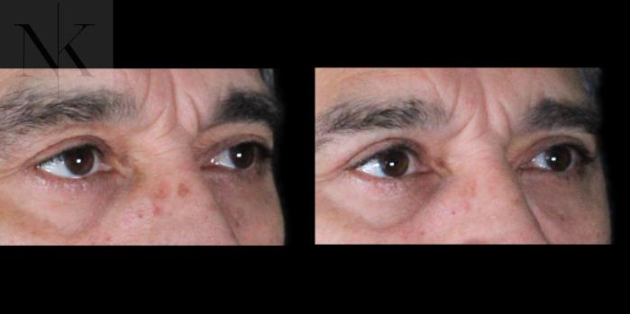 Before & After Upper Blepharoplasty Case 195 Right Oblique View in Wethersfield, Hartford, Nebraska