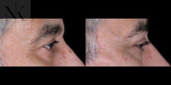 Before & After Upper Blepharoplasty Case 195 Right Side View in Wethersfield, Hartford, Nebraska