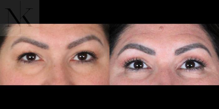 Before & After Upper Blepharoplasty Case 198 Front View in Wethersfield, Hartford, Nebraska