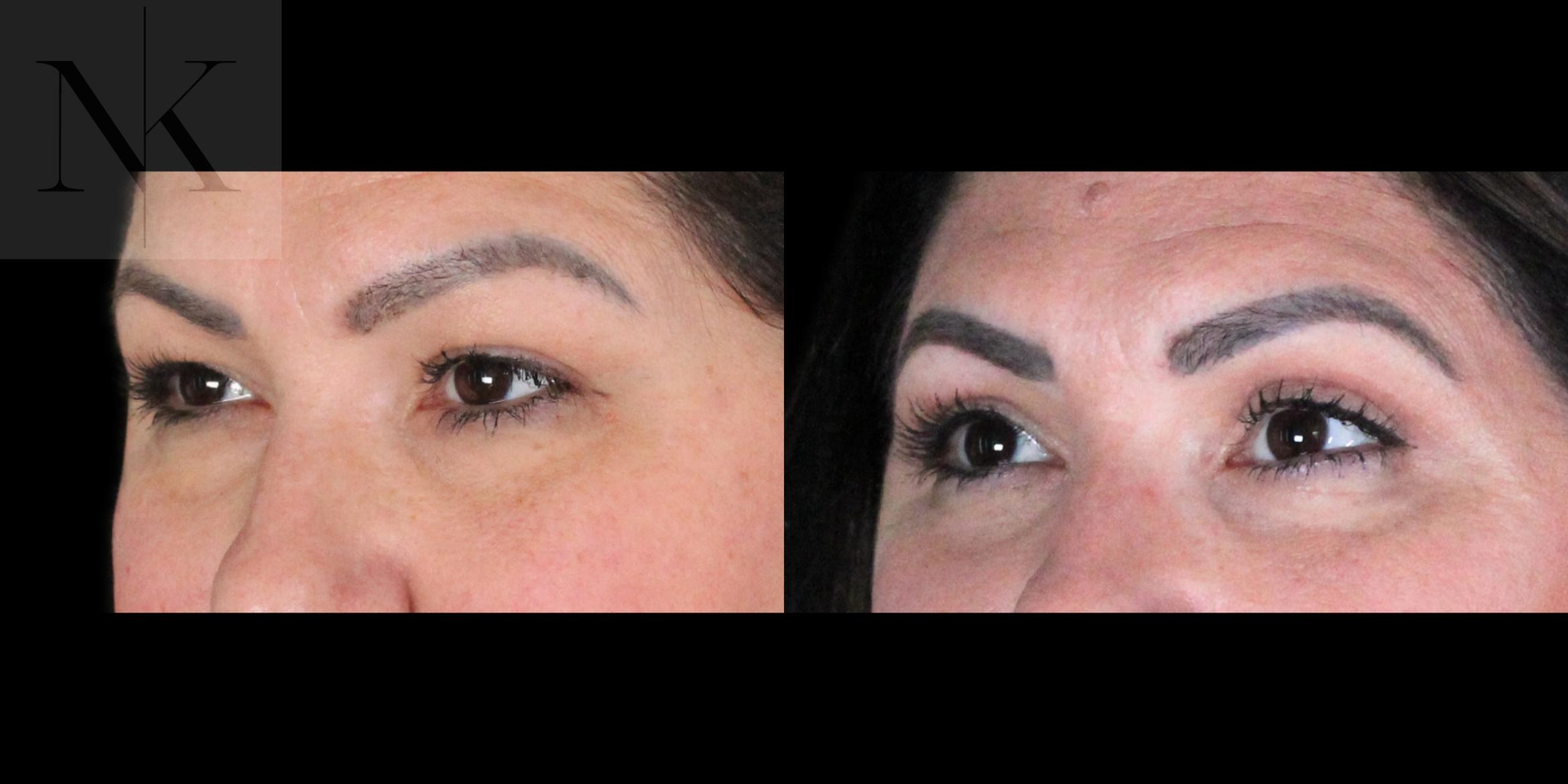 Before & After Upper Blepharoplasty Case 198 Left Oblique View in Wethersfield, Hartford, Nebraska