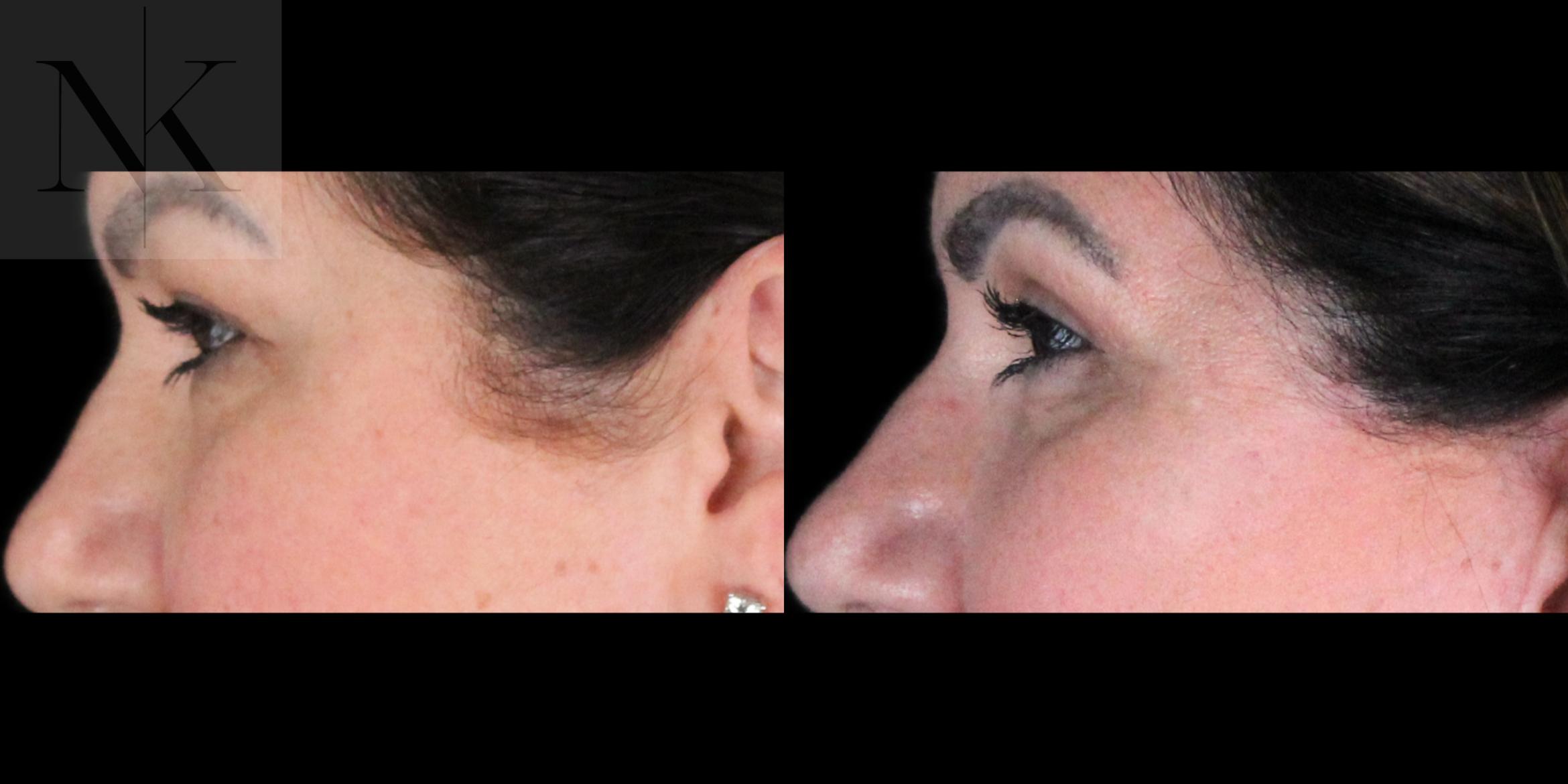 Before & After Upper Blepharoplasty Case 198 Left Side View in Wethersfield, Hartford, Nebraska