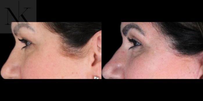 Before & After Upper Blepharoplasty Case 198 Left Side View in Wethersfield, Hartford, Nebraska