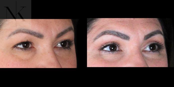 Before & After Upper Blepharoplasty Case 198 Right Oblique View in Wethersfield, Hartford, Nebraska