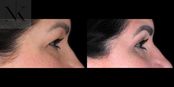 Before & After Upper Blepharoplasty Case 198 Right Side View in Wethersfield, Hartford, Nebraska