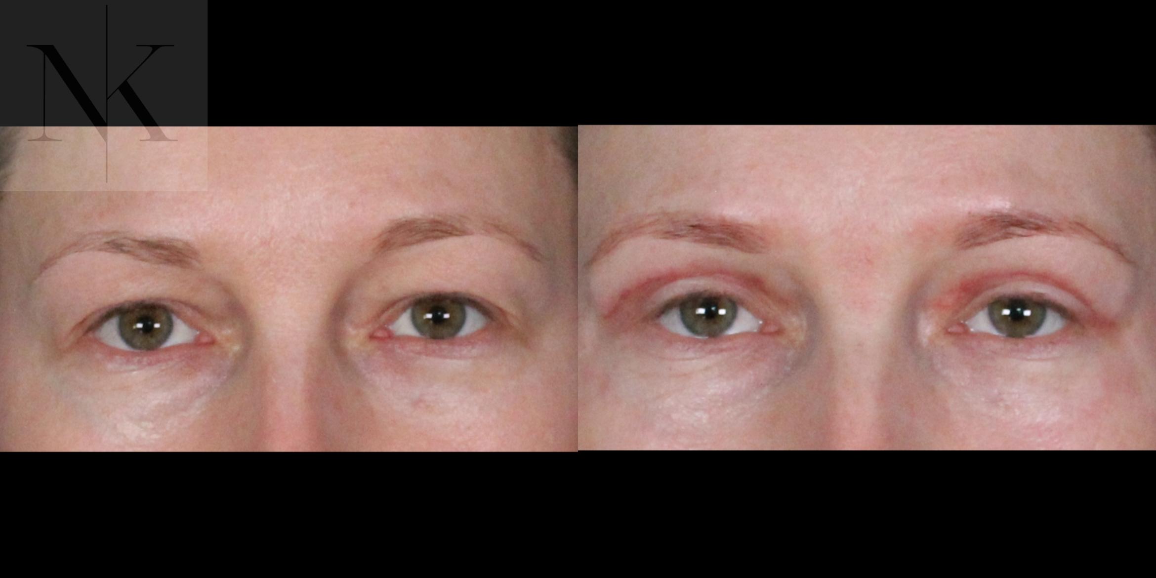 Before & After Upper Blepharoplasty Case 200 Front View in Wethersfield, Hartford, Nebraska