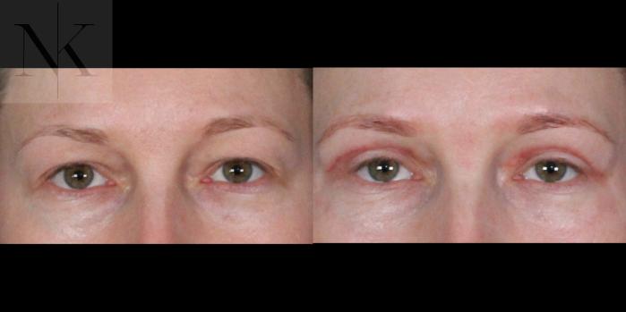 Before & After Upper Blepharoplasty Case 200 Front View in Wethersfield, Hartford, Nebraska